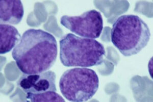 Webcast: Advancing Molecular Diagnostics in Blood Cancer Management